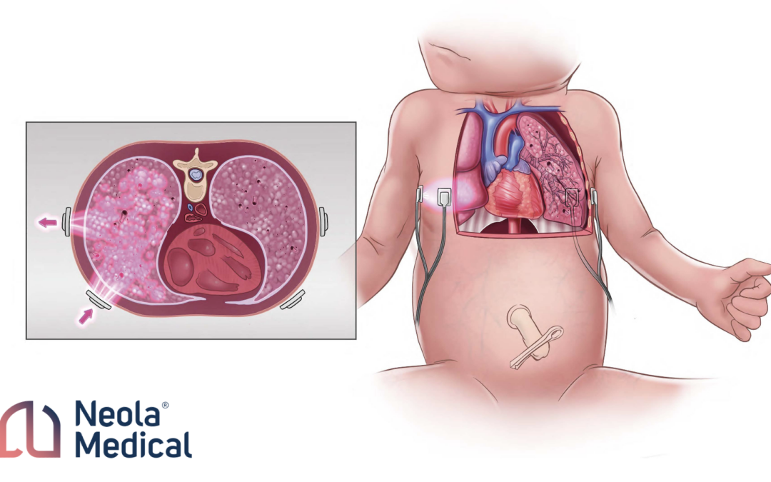 Clinical potential in neonatal respiratory monitoring with Neola®’s GASMAS technology