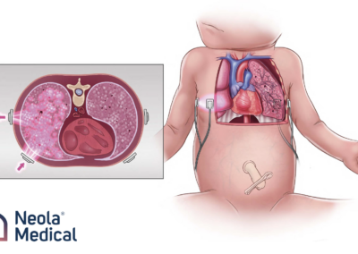 Clinical potential in neonatal respiratory monitoring with Neola®’s GASMAS technology